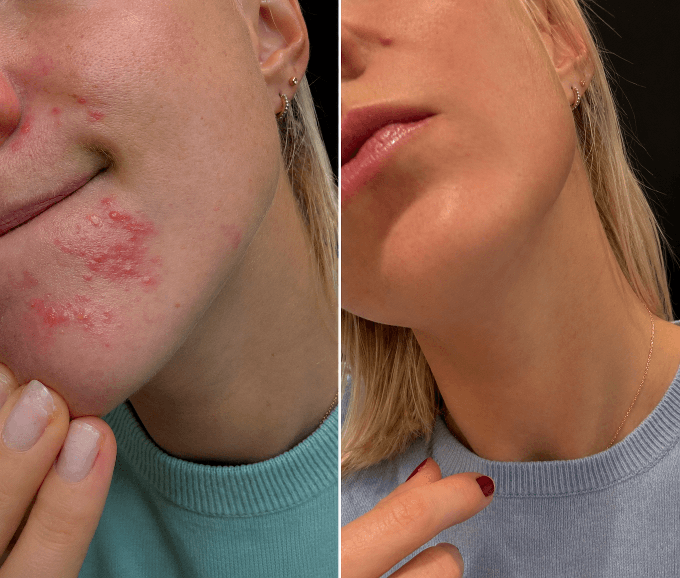 Avant après, rituel BLORËM & SENS sur imperfections et éclat